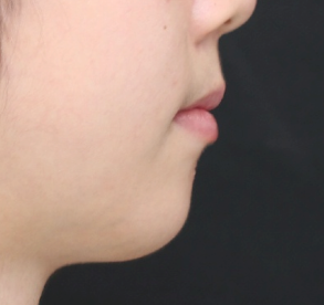 小希治疗后侧貌